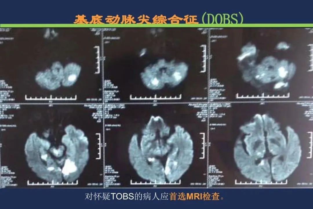 从梗死部位推测责任血管：脑血管解剖-205