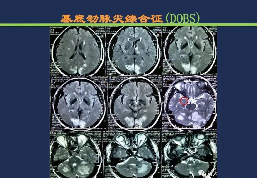从梗死部位推测责任血管：脑血管解剖-208