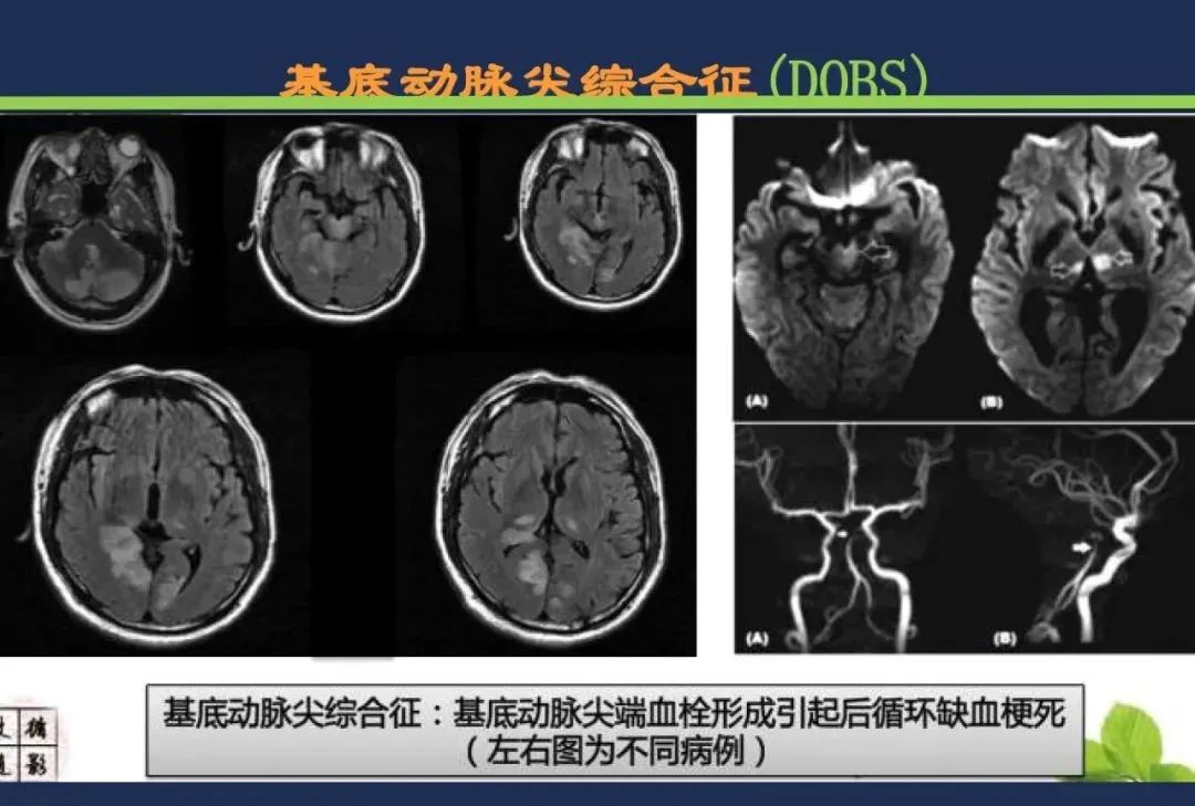 从梗死部位推测责任血管：脑血管解剖-212