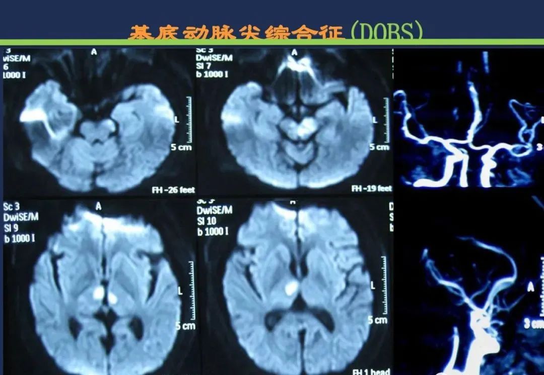 从梗死部位推测责任血管：脑血管解剖-210