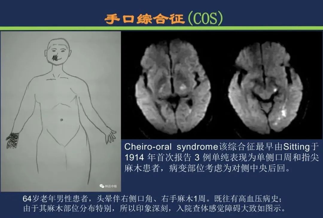 从梗死部位推测责任血管：脑血管解剖-214