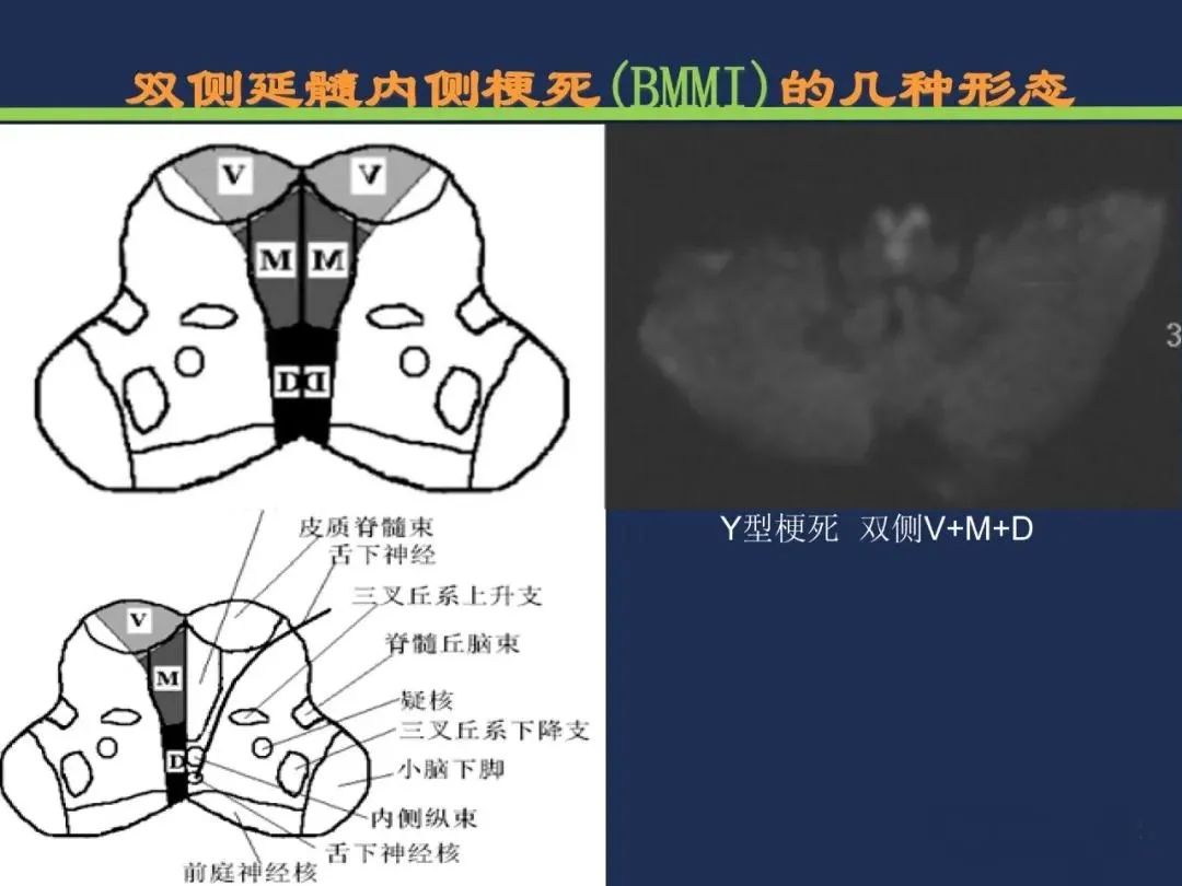从梗死部位推测责任血管：脑血管解剖-202