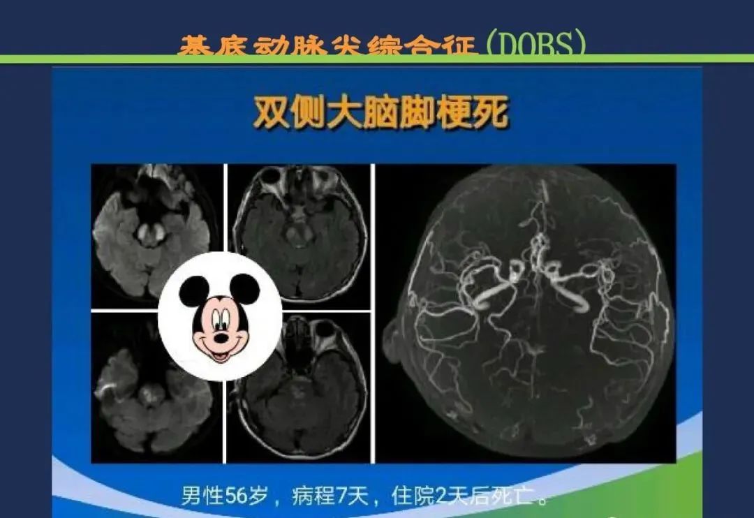 从梗死部位推测责任血管：脑血管解剖-211