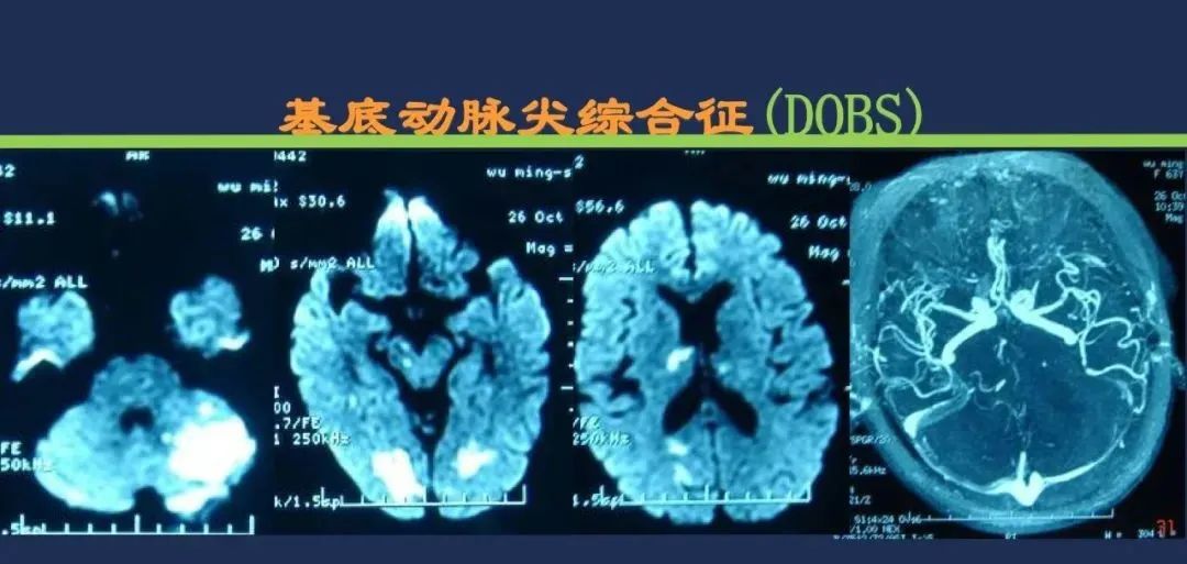 从梗死部位推测责任血管：脑血管解剖-209