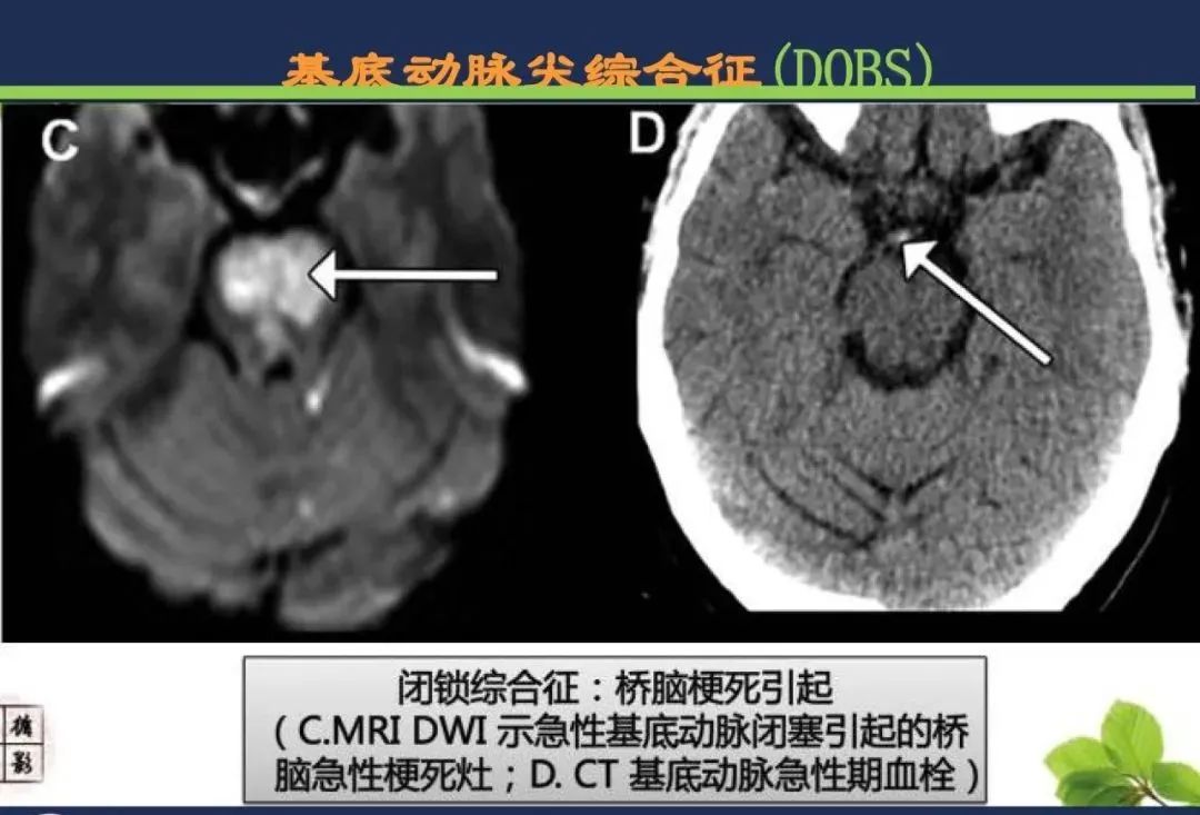 从梗死部位推测责任血管：脑血管解剖-213