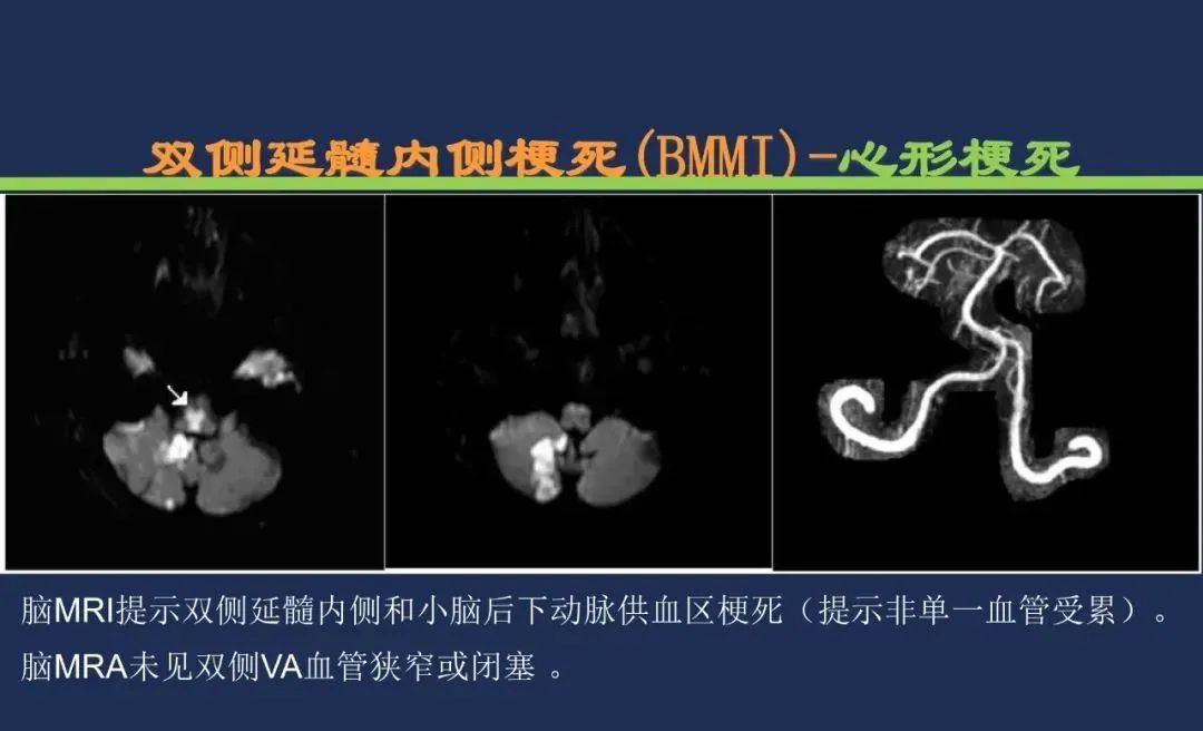 从梗死部位推测责任血管：脑血管解剖-199