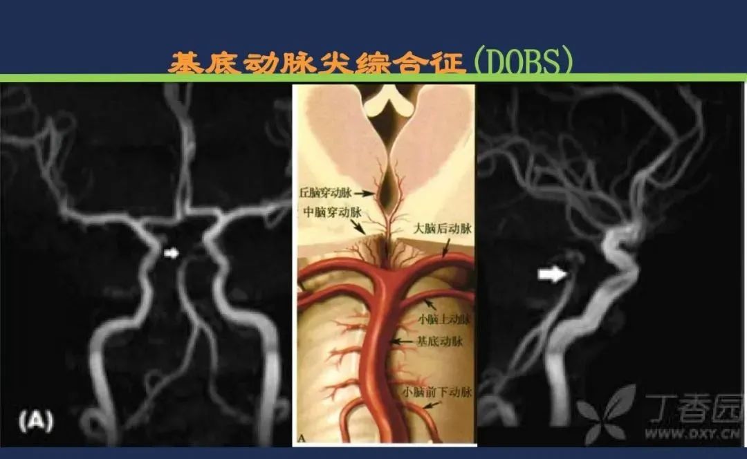从梗死部位推测责任血管：脑血管解剖-206