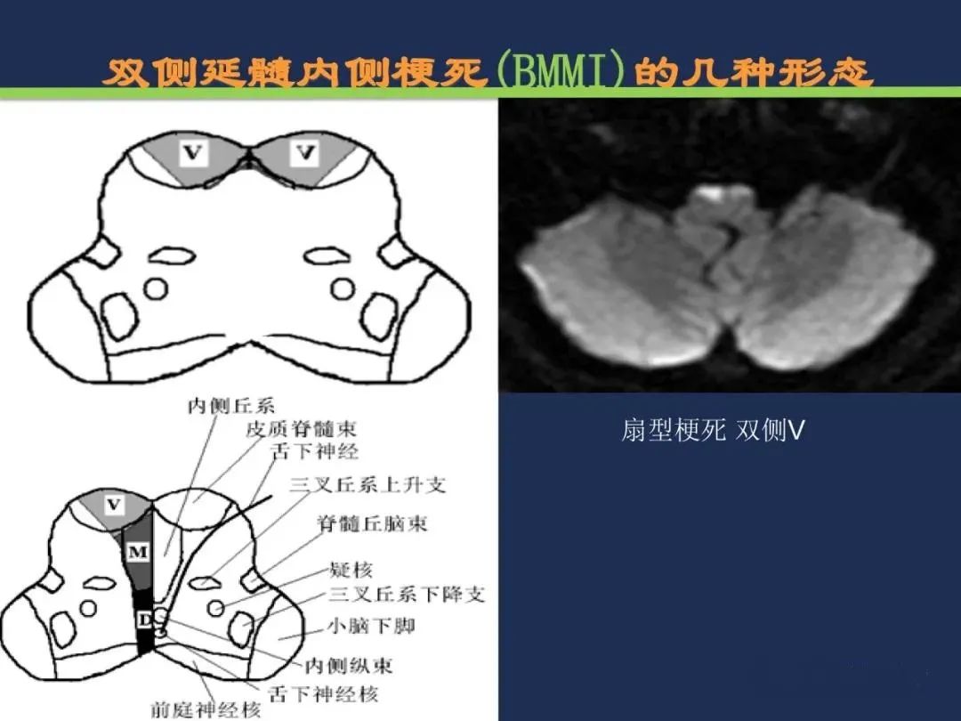 从梗死部位推测责任血管：脑血管解剖-203