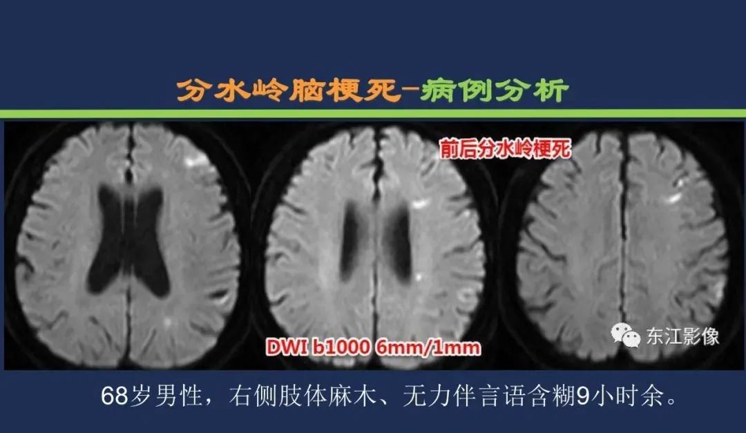 从梗死部位推测责任血管：脑血管解剖-246