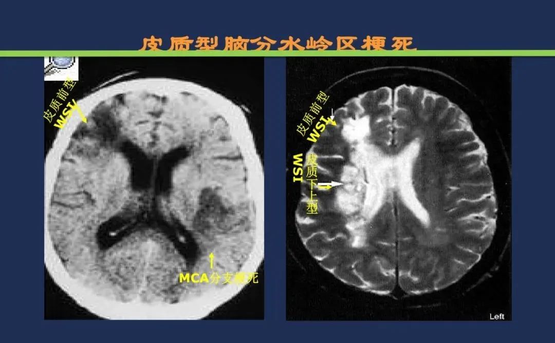 从梗死部位推测责任血管：脑血管解剖-241