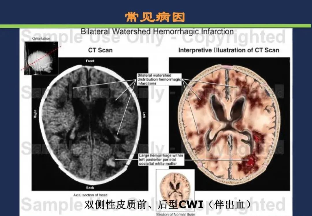 从梗死部位推测责任血管：脑血管解剖-221