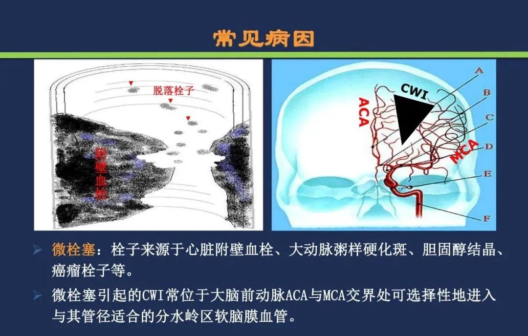 从梗死部位推测责任血管：脑血管解剖-223