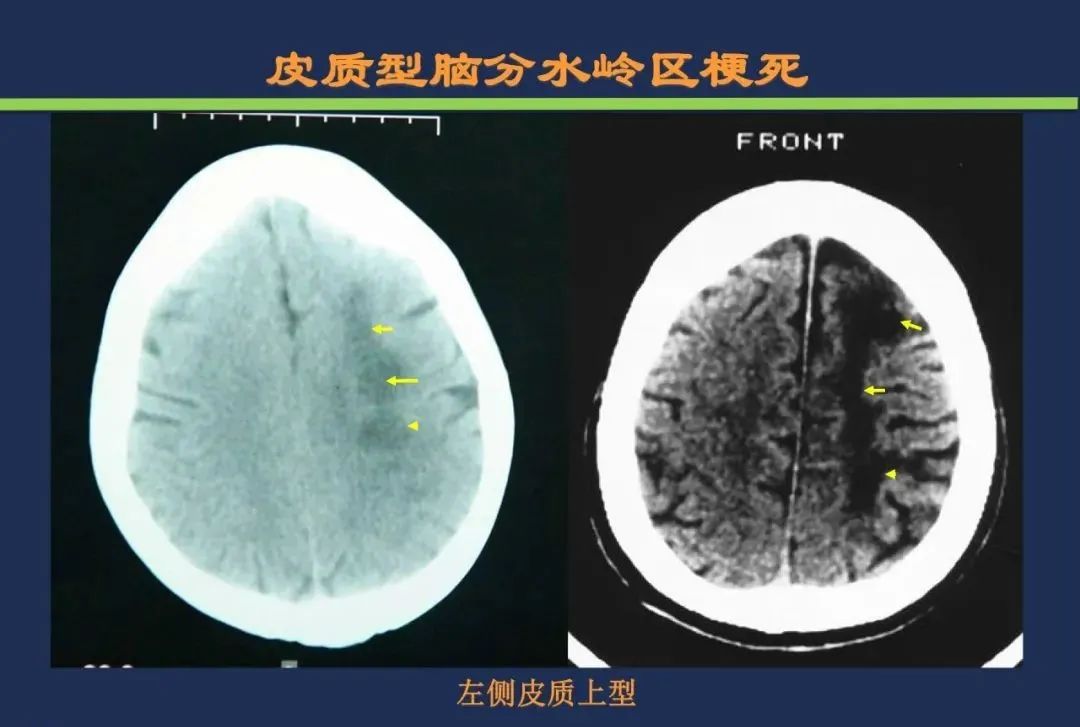 从梗死部位推测责任血管：脑血管解剖-243