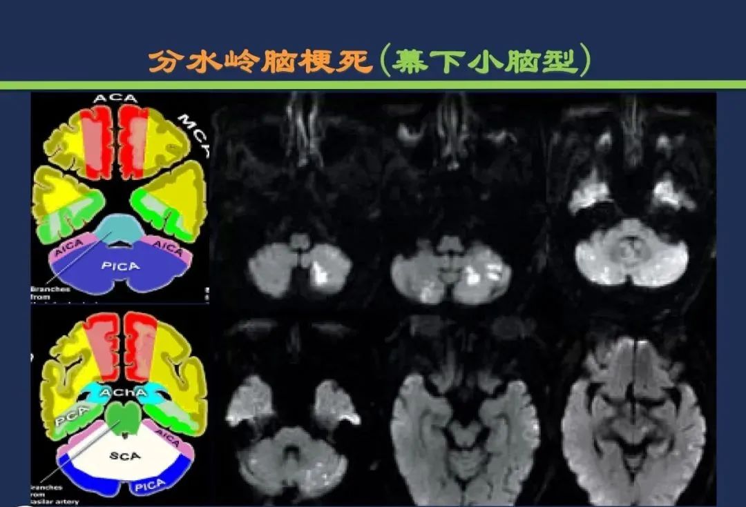 从梗死部位推测责任血管：脑血管解剖-255
