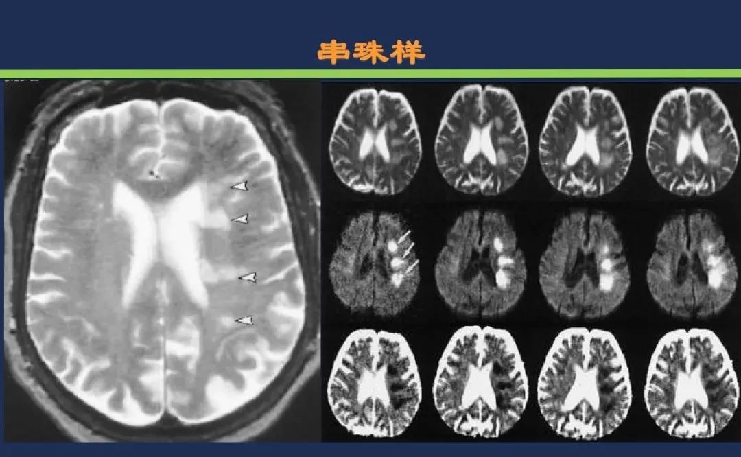 从梗死部位推测责任血管：脑血管解剖-226