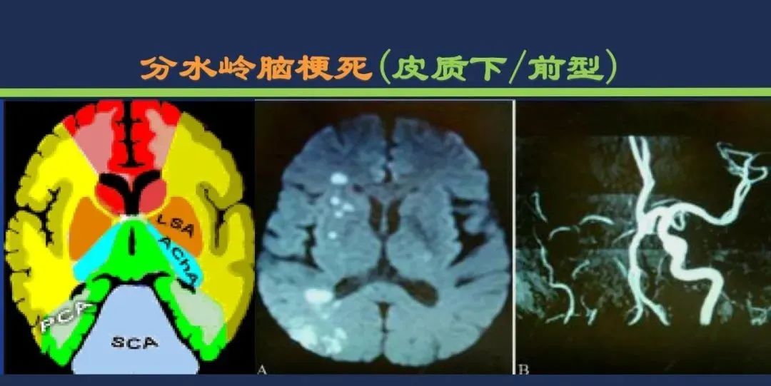 从梗死部位推测责任血管：脑血管解剖-253