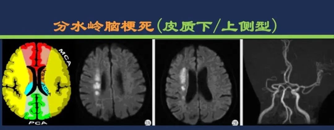 从梗死部位推测责任血管：脑血管解剖-254