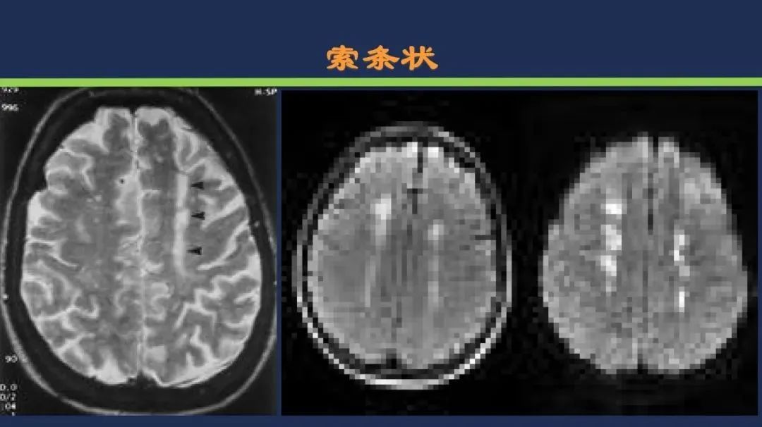 从梗死部位推测责任血管：脑血管解剖-228