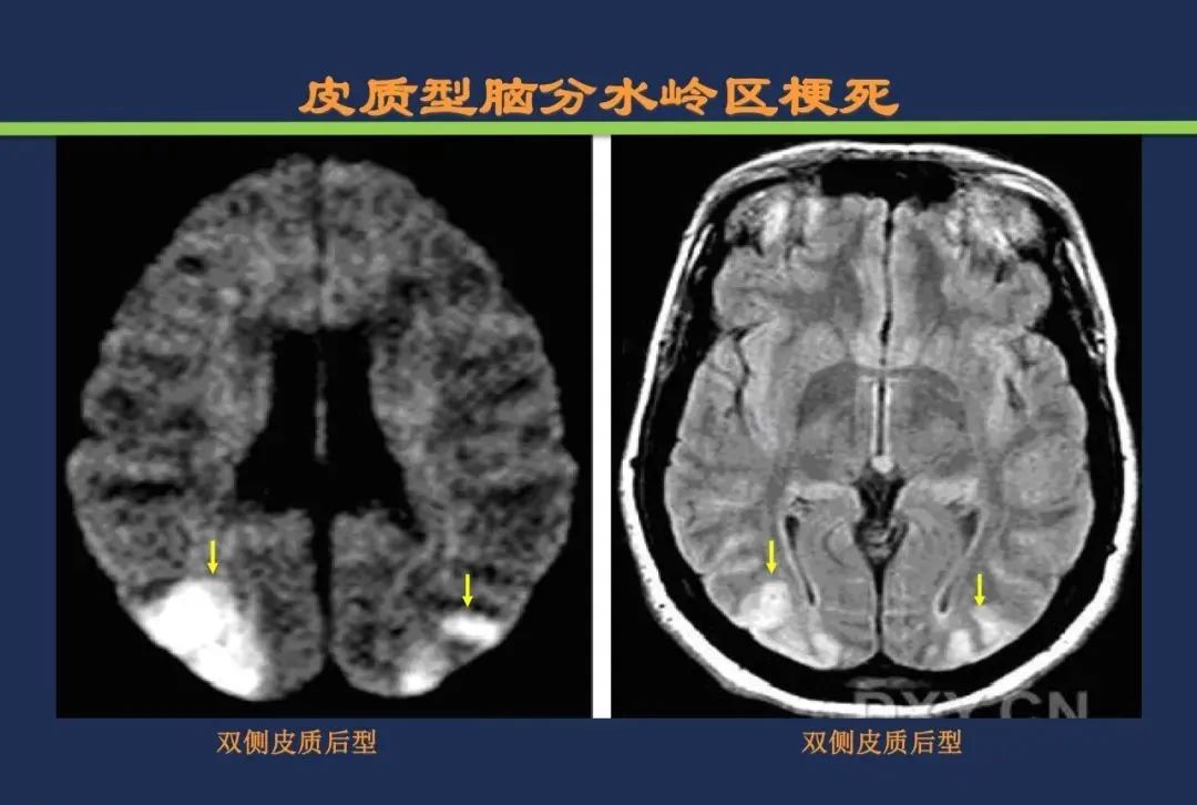 从梗死部位推测责任血管：脑血管解剖-242