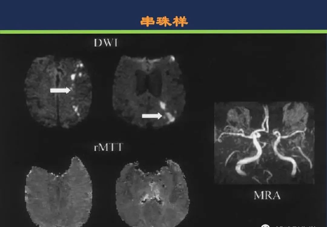 从梗死部位推测责任血管：脑血管解剖-227