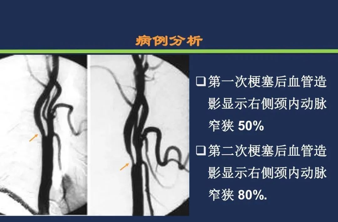 从梗死部位推测责任血管：脑血管解剖-244