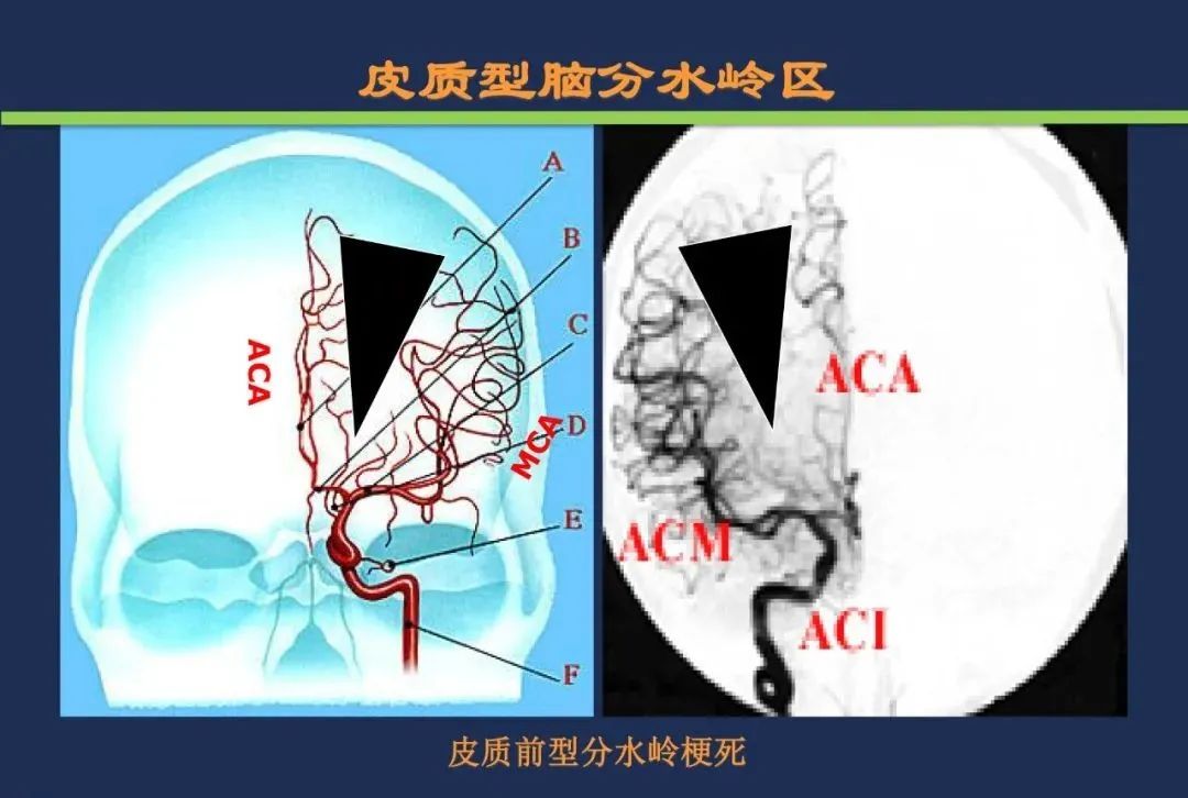 从梗死部位推测责任血管：脑血管解剖-238