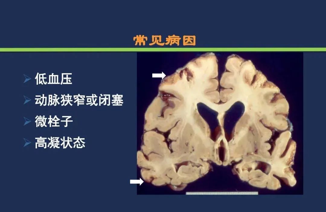 从梗死部位推测责任血管：脑血管解剖-219