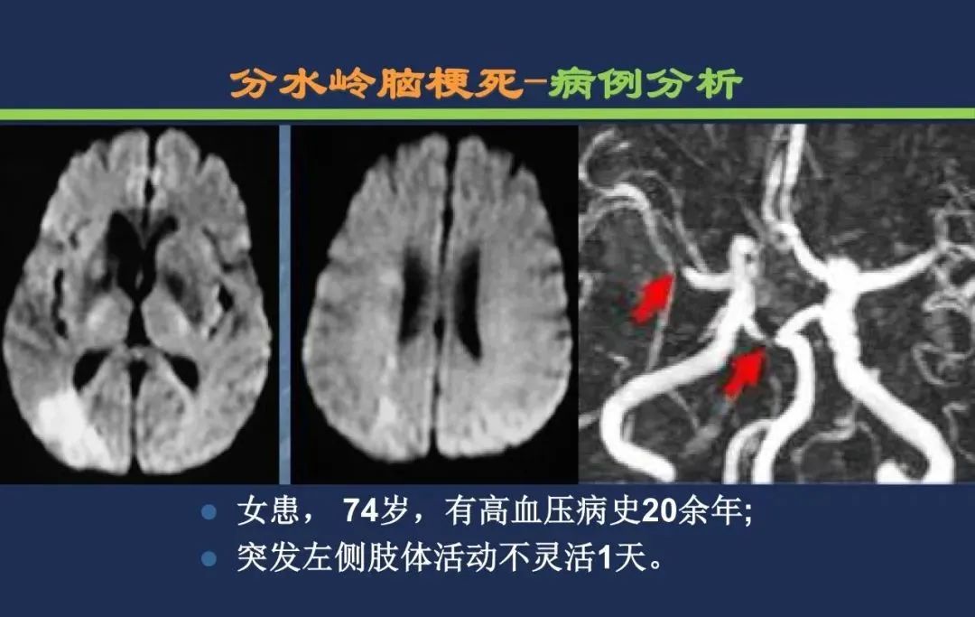 从梗死部位推测责任血管：脑血管解剖-250