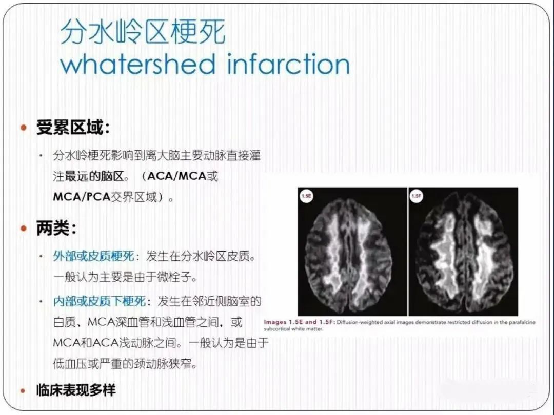 从梗死部位推测责任血管：脑血管解剖-234