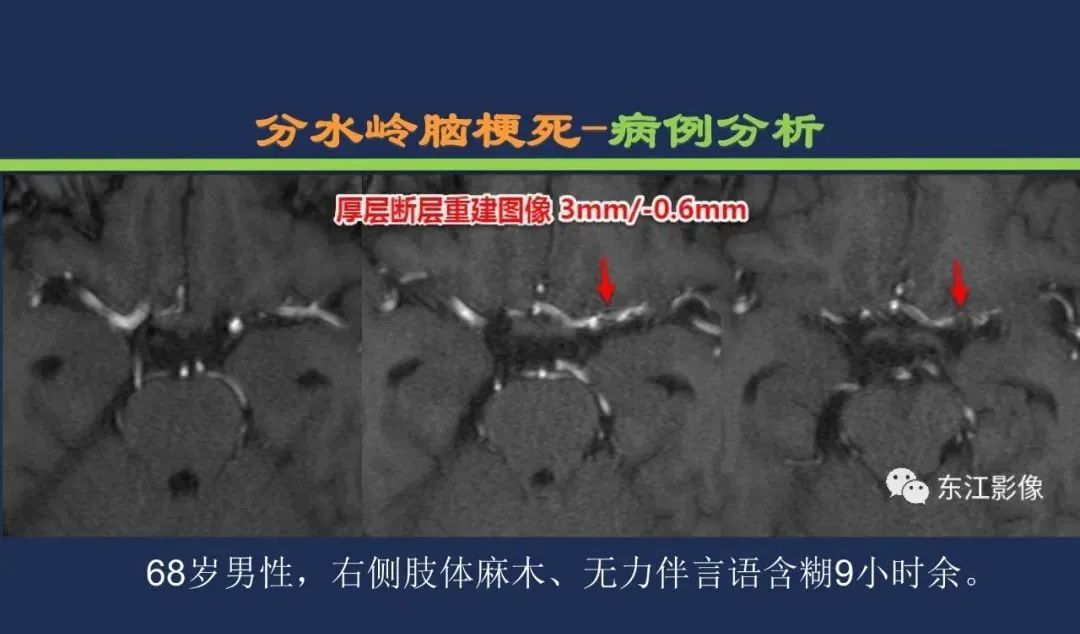 从梗死部位推测责任血管：脑血管解剖-247