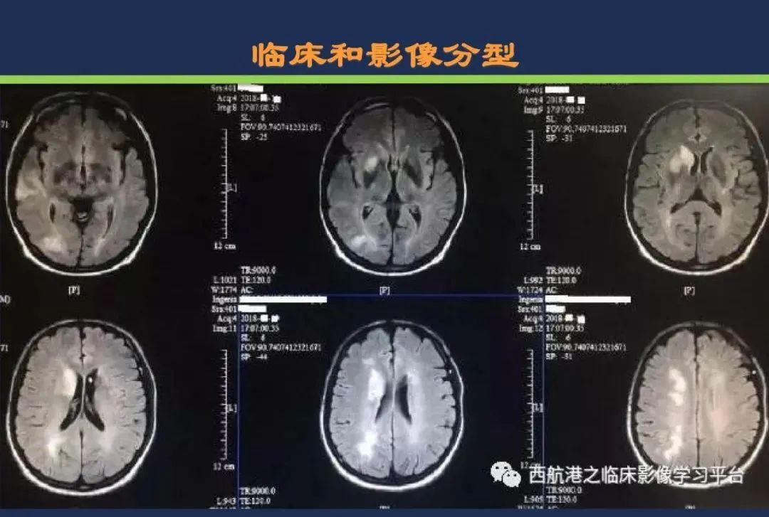 从梗死部位推测责任血管：脑血管解剖-235