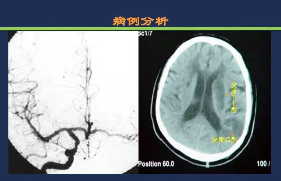 从梗死部位推测责任血管：脑血管解剖-245