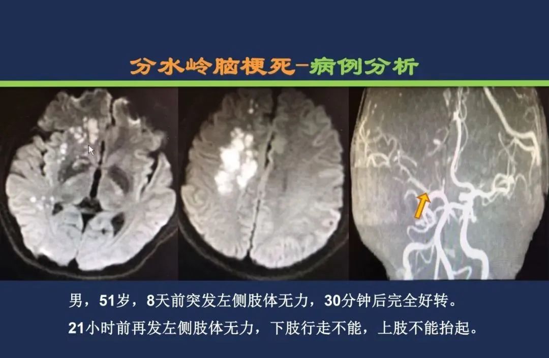 从梗死部位推测责任血管：脑血管解剖-251