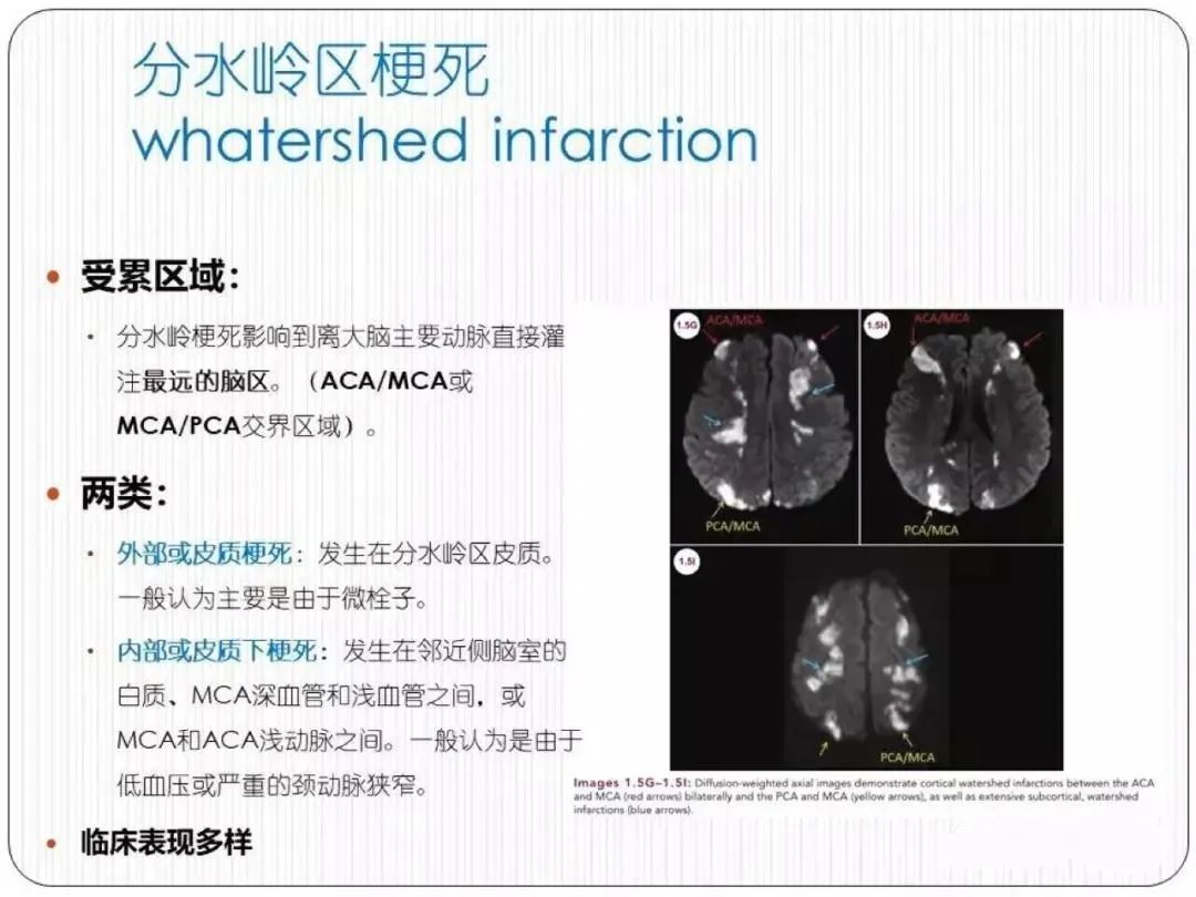 从梗死部位推测责任血管：脑血管解剖-232