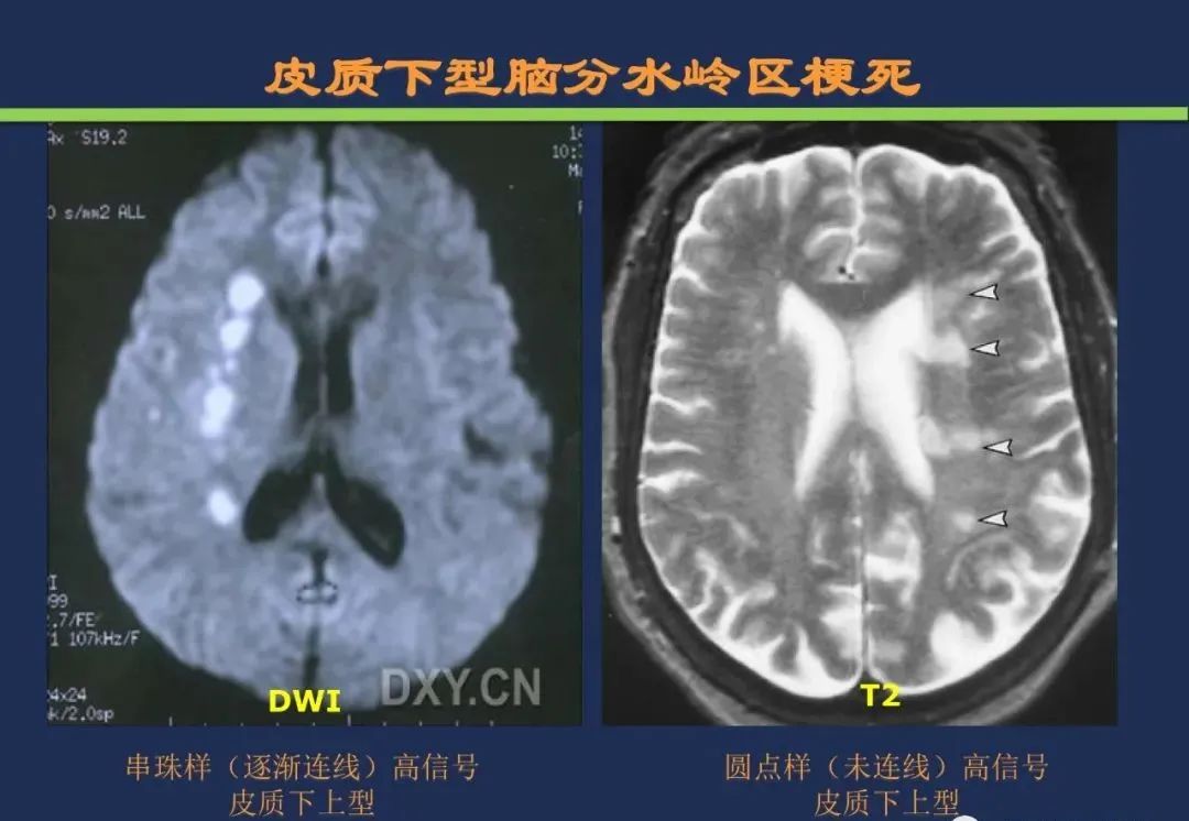 从梗死部位推测责任血管：脑血管解剖-249