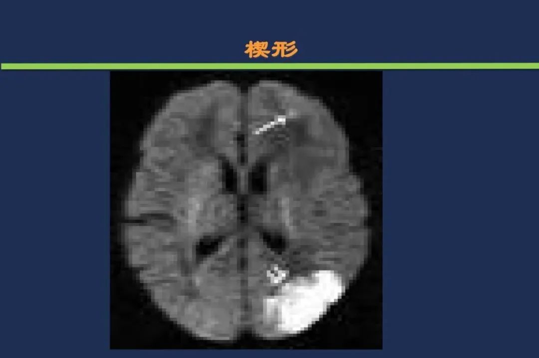 从梗死部位推测责任血管：脑血管解剖-229