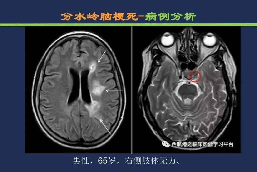 从梗死部位推测责任血管：脑血管解剖-252