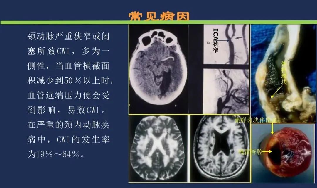 从梗死部位推测责任血管：脑血管解剖-222