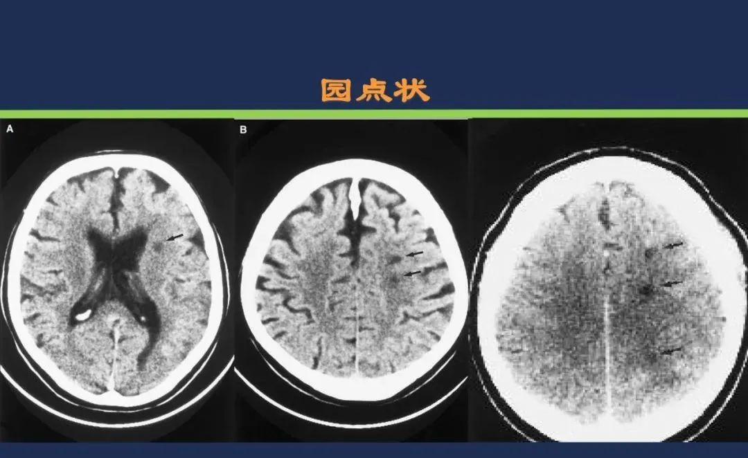 从梗死部位推测责任血管：脑血管解剖-225