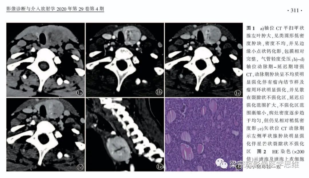 【病例】甲状腺腺瘤1例影像诊断思维-4