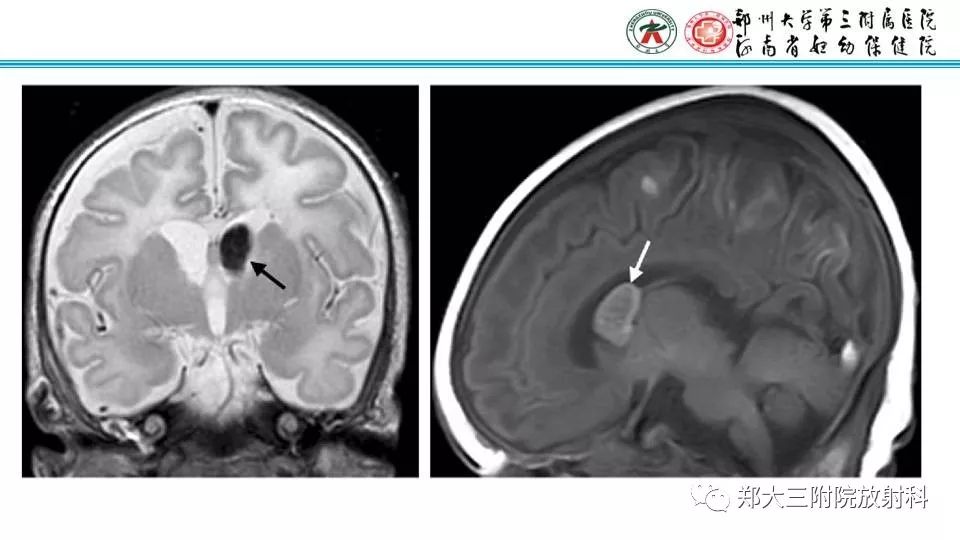 【PPT】室周假性囊肿-16