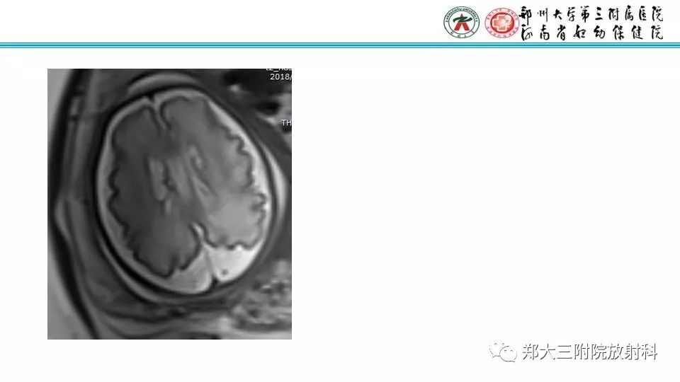 【PPT】室周假性囊肿-17
