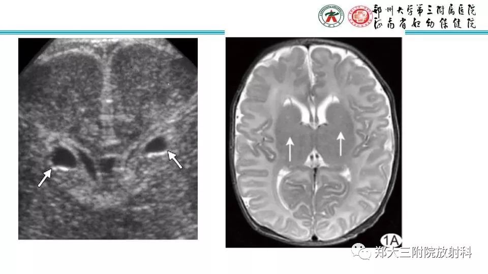 【PPT】室周假性囊肿-9