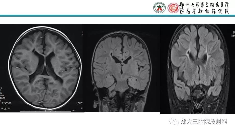 【PPT】室周假性囊肿-21