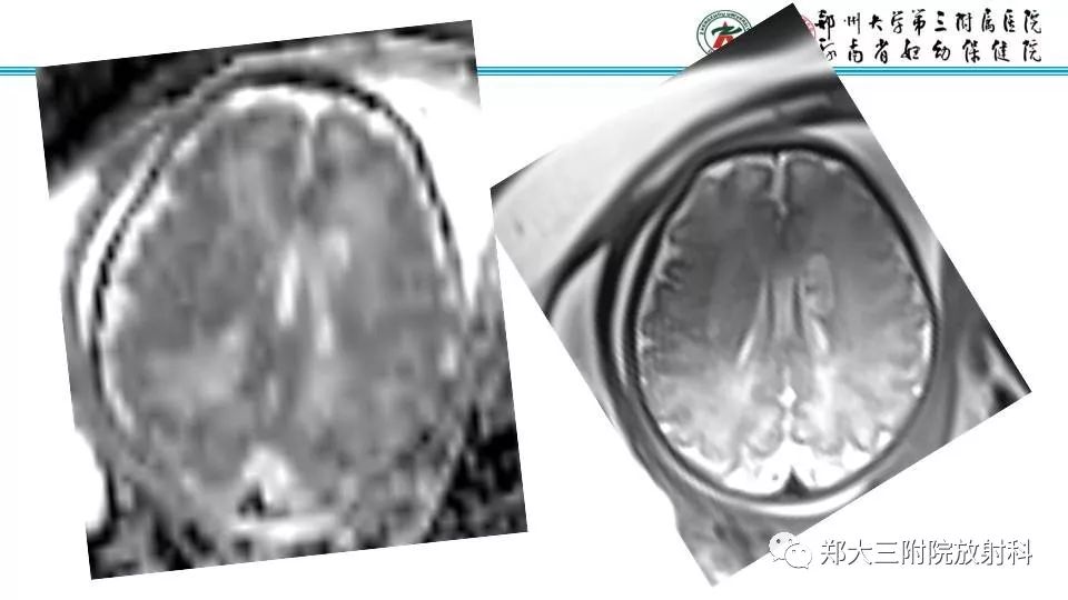 【PPT】室周假性囊肿-19