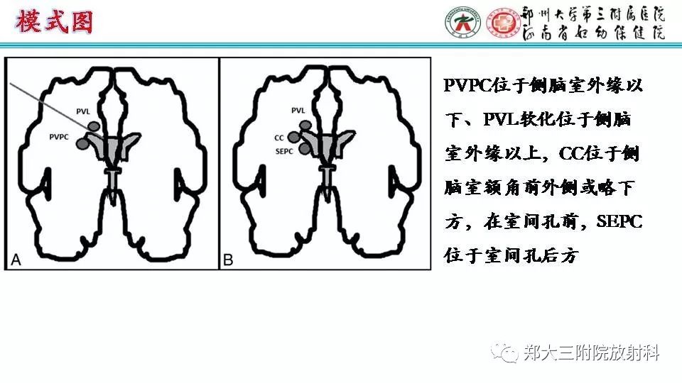 【PPT】室周假性囊肿-6
