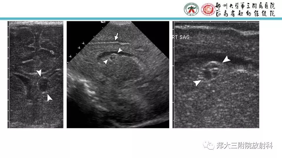 【PPT】室周假性囊肿-15