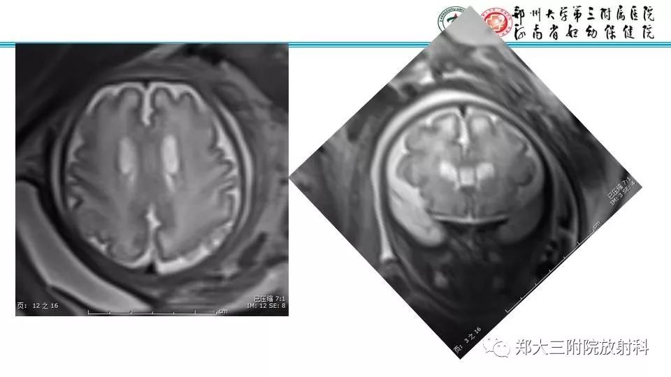 【PPT】室周假性囊肿-11