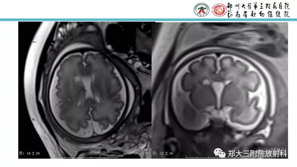 【PPT】室周假性囊肿-10