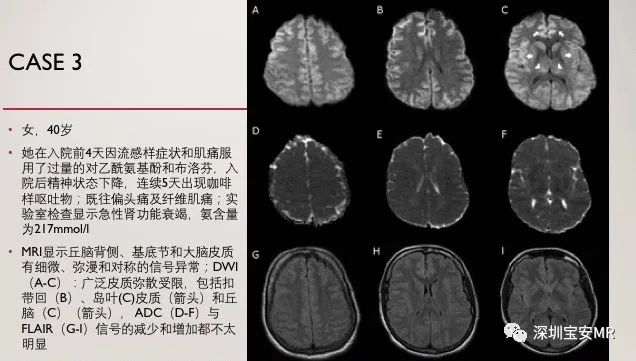急性高氨血症脑病的影像表现-3